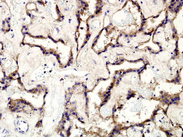 5D2 Choroid Plexus Papilloma (Case 5) Transthyretin 3.jpg