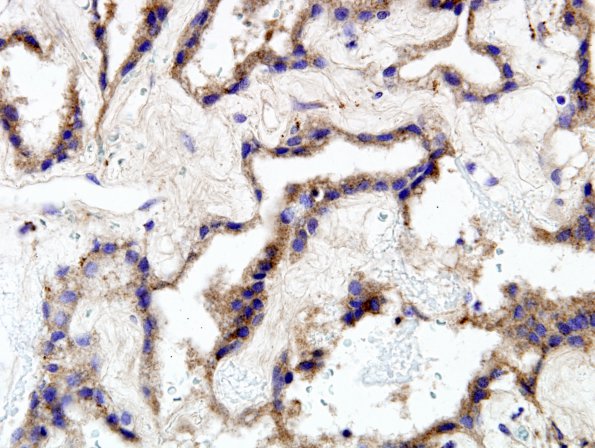 5D3 Choroid Plexus Papilloma (Case 5) Transthyretin 1.jpg