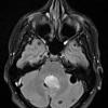 6A1 Choroid Plexus Papilloma & mutiple cysts (Case 6) FLAIR 2 - Copy