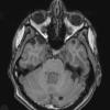 6A2 Choroid Plexus Papilloma & mutiple cysts (Case 6) T1 1 - Copy