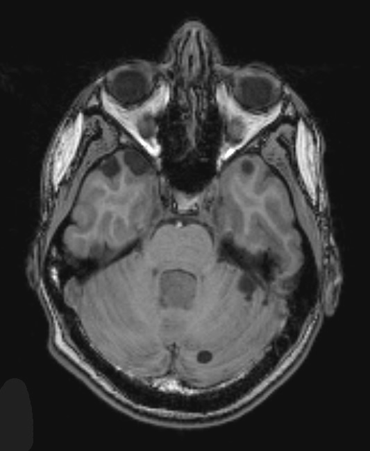 6A2 Choroid Plexus Papilloma & mutiple cysts (Case 6) T1 1 - Copy