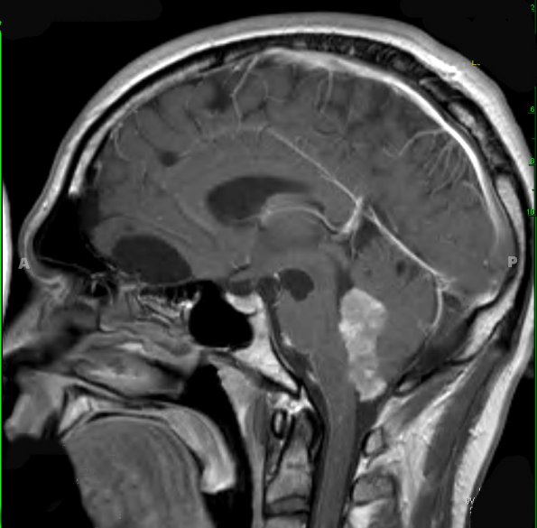 6A3 Choroid Plexus Papilloma & mutiple cysts (Case 6) T1 W 3 - Copy