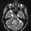 6A4 Choroid Plexus Papilloma & mutiple cysts (Case 6) T2 W 3 - Copy