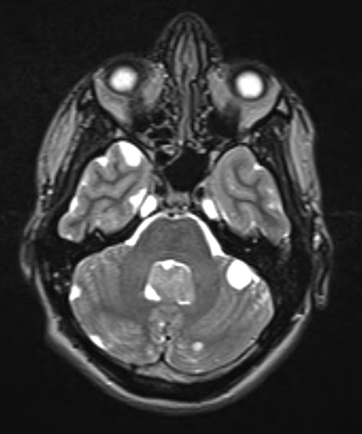 6A4 Choroid Plexus Papilloma & mutiple cysts (Case 6) T2 W 3 - Copy