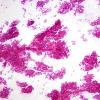 6B0 Choroid Plexus Papilloma smear (Case 6) H&E.jpg