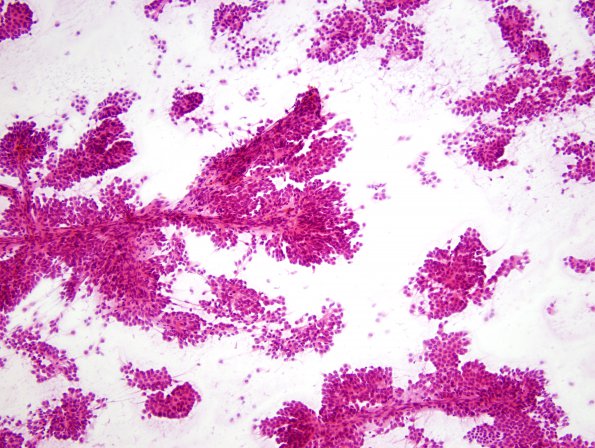 6B0 Choroid Plexus Papilloma smear (Case 6) H&E.jpg