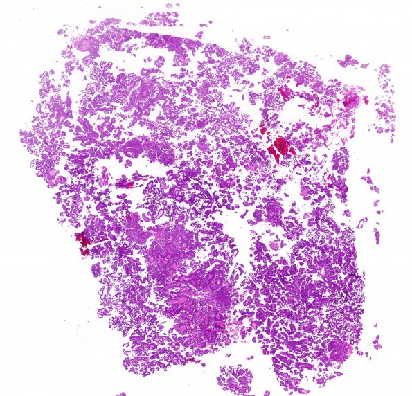 6B1 Choroid Plexus Papilloma (Case 6) H&E whole mount