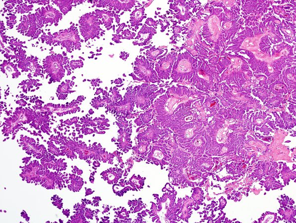 6B2 Choroid Plexus Papilloma (Case 6) H&E 2.jpg