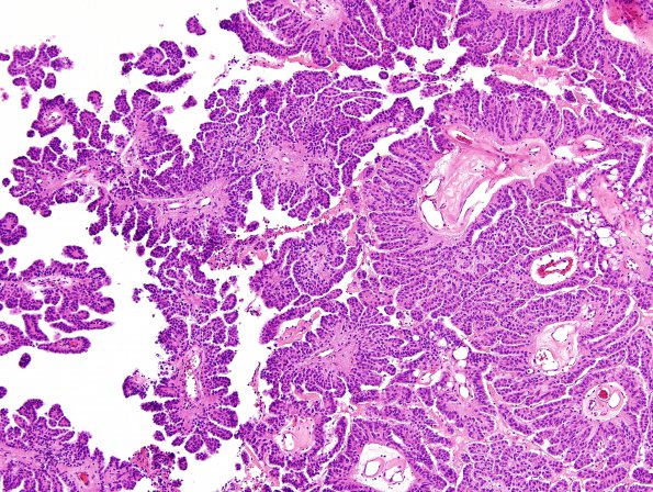 6B3 Choroid Plexus Papilloma (Case 6) H&E 3.jpg