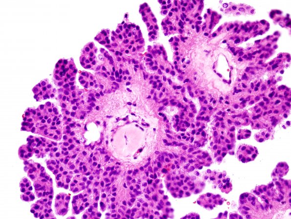 6B4 Choroid Plexus Papilloma (Case 6) H&E 8.jpg