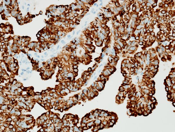 6C2 Choroid Plexus Papilloma (Case 6) CAM52 4.jpg