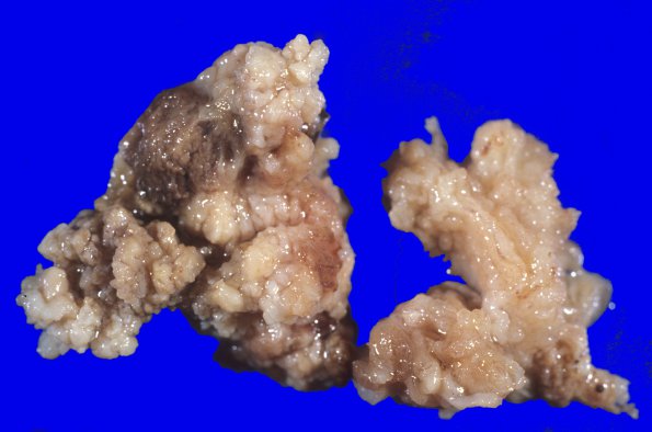 7A3 Choroid Plexus Papilloma (Case 7) 3