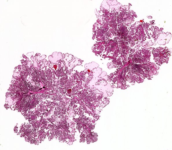 8A1 Choroid Plexus Papilloma (Case 8)