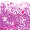 8A2 Choroid Plexus Papilloma (Case 8) 2X