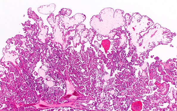 8A2 Choroid Plexus Papilloma (Case 8) 2X