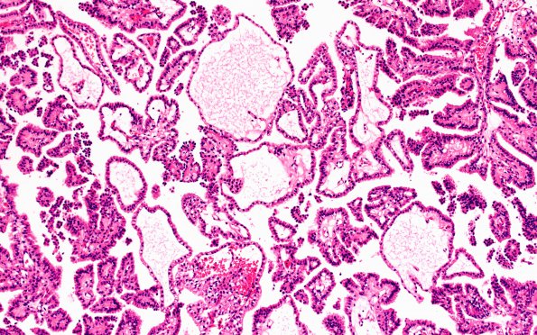 8A3 Choroid Plexus Papilloma (Case 8) 10X