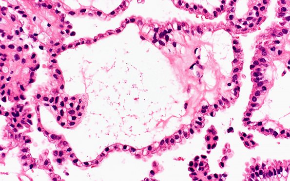 8A4 Choroid Plexus Papilloma (Case 8) 40X