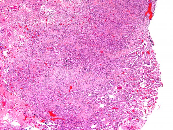 9A1 Choroid Plexus Papilloma (Case 9) -H&E_6.jpg