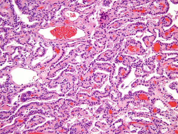 9A2 Choroid Plexus Papilloma (Case 9) -H&E_3jpg.jpg