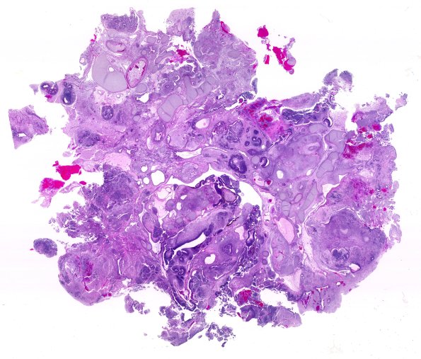 1A2 Teratoma, immature (Case 1) H&E WM