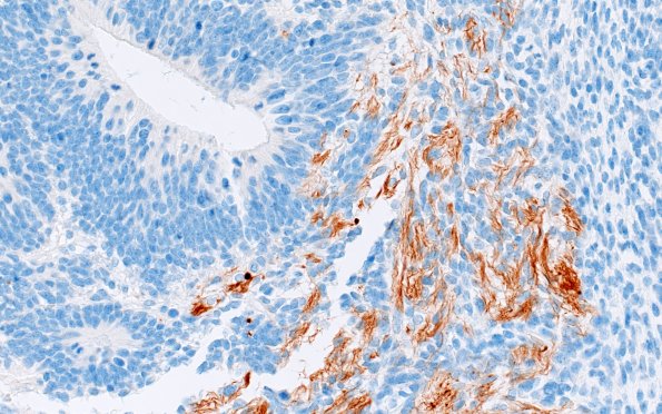 1H2 Teratoma, immature (Case 1) NF 40X 2