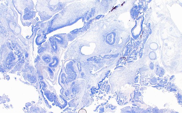 1H3 Teratoma, immature (Case 1) NeuN 2X