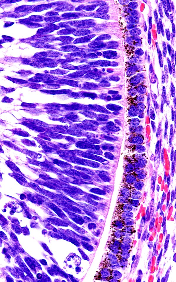 1I5 Teratoma, immature (Case 1) H&E 100X