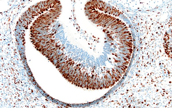1J1 Teratoma, immature (Case 1) Ki67 20X 4