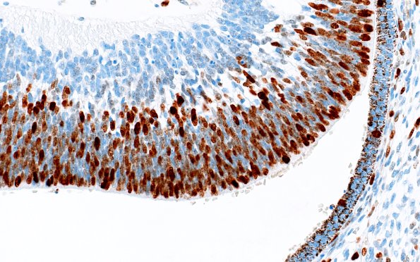 1J2 Teratoma, immature (Case 1) Ki67 40X 2