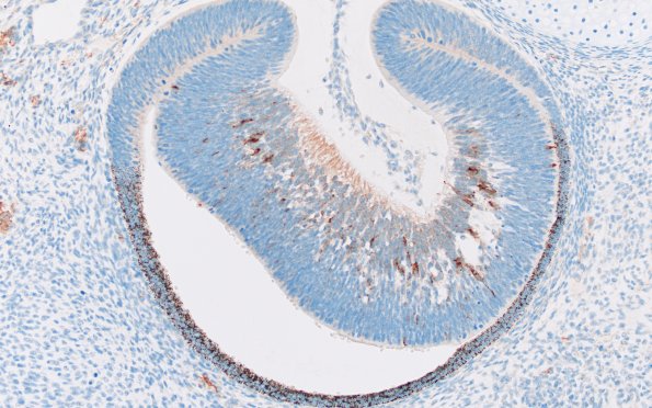 1K1 Teratoma, immature (Case 1 SYN 20X 4