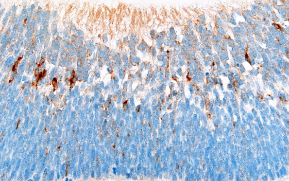 1K3 Teratoma, immature (Case 1) SYN 60X 2