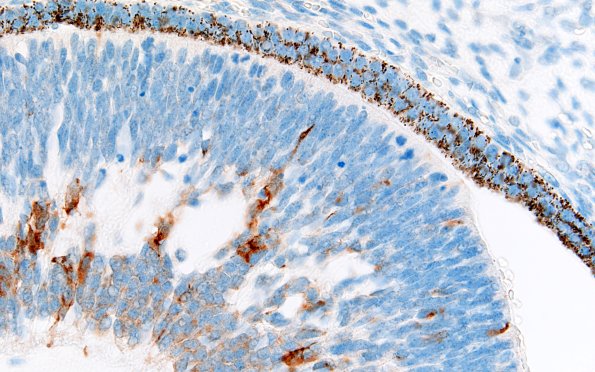 1K4 Teratoma, immature (Case 1) SYN 60X 3