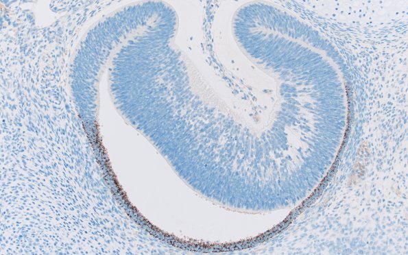 1L1 Teratoma, immature (Case 1) NF 20X 4