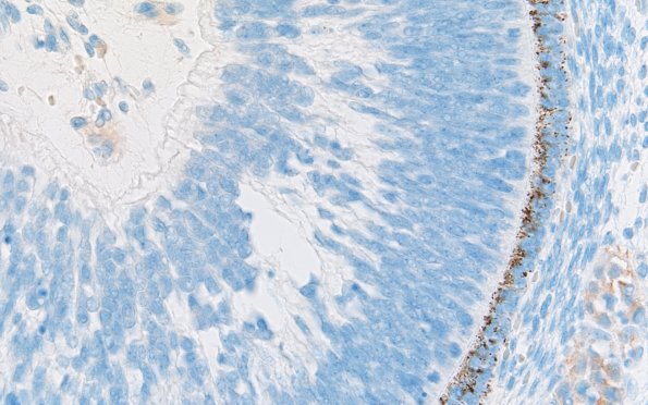 1L2 Teratoma, immature (Case 1) NF 40X 4