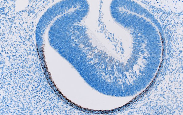 1L3 Teratoma, immature (Case 1) NeuN 20X 5