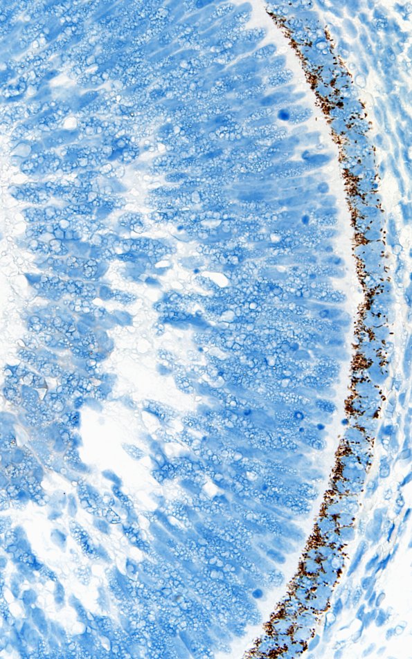 1L4 Teratoma, immature (Case 1) NeuN 60X 1A