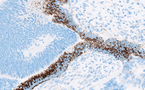 1L5 Teratoma, immature (Case 1) NF 40X 5