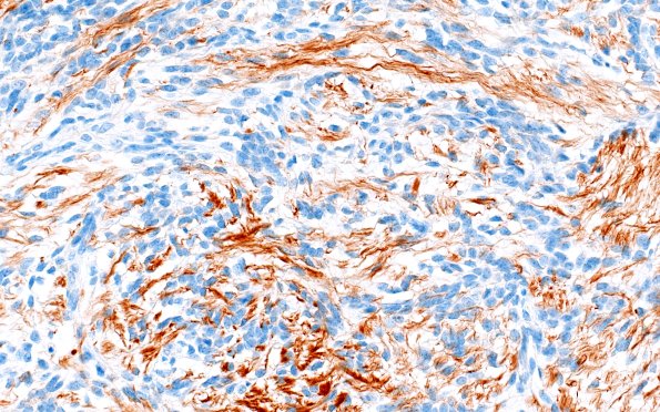 1N3B Immature teratoma (Case 1) NF 40X 2