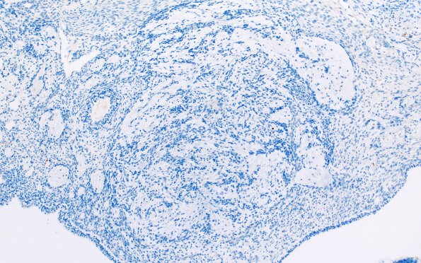 1N4A Immature teratoma (Case 1) GFAP 10X 2
