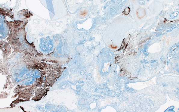 1P2Teratoma, immature (Case 1) GFAP 2X