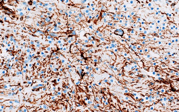 1P4 Teratoma, immature (Case 1) GFAP 40X