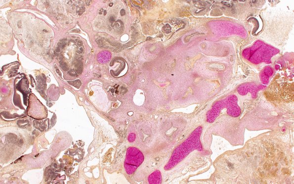 1R1 Teratoma, immature (Case 1) Mucicarmine 2X 1