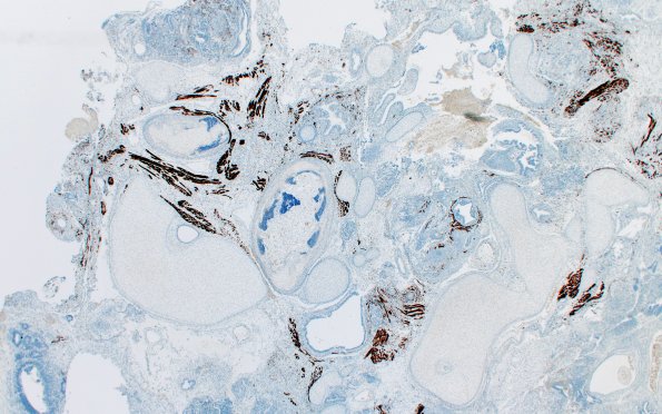 1T1 Teratoma, immature (Case 1) Desmin 2X