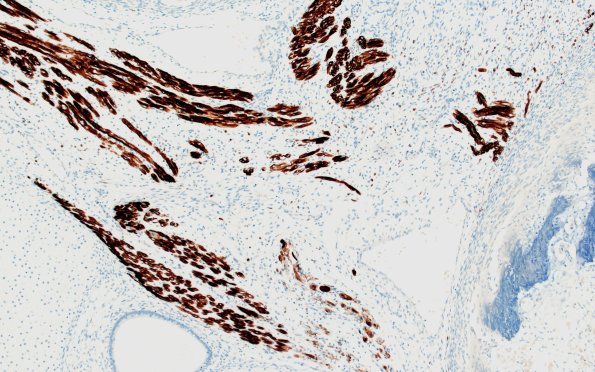 1T2 Teratoma, immature (Case 1) Desmin 10X