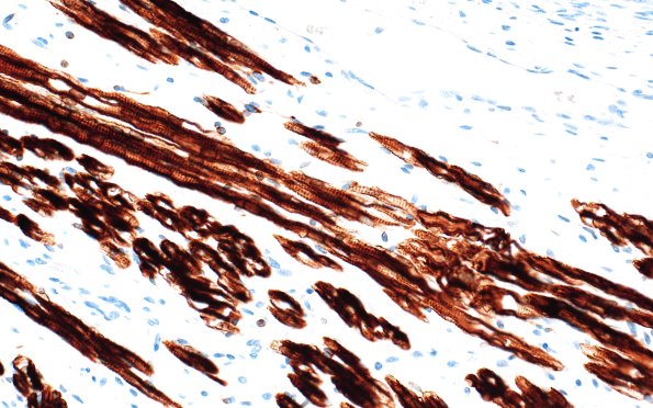 1T3 Teratoma, immature (Case 1) Desmin 40X
