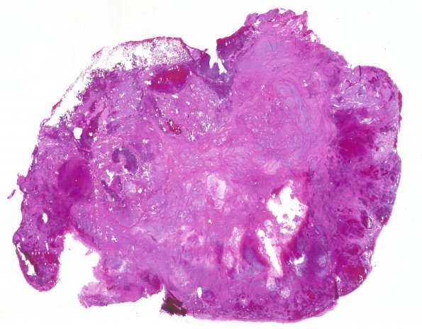 1B1 Choriocarcinoma 5 (Case 1) whole mount A