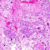 1B2 Choriocarcinoma (Case 1) 4 copy