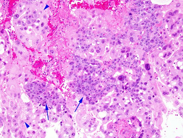 1B2 Choriocarcinoma (Case 1) 4 copy