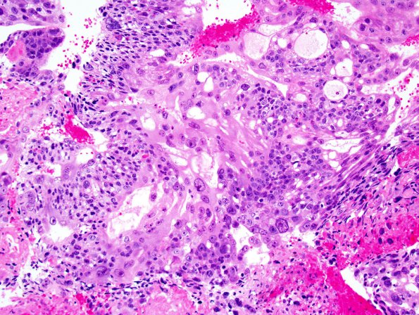 1B3 Choriocarcinoma (Case 1) 1