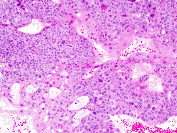 1B4 Choriocarcinoma (Case 1) 2
